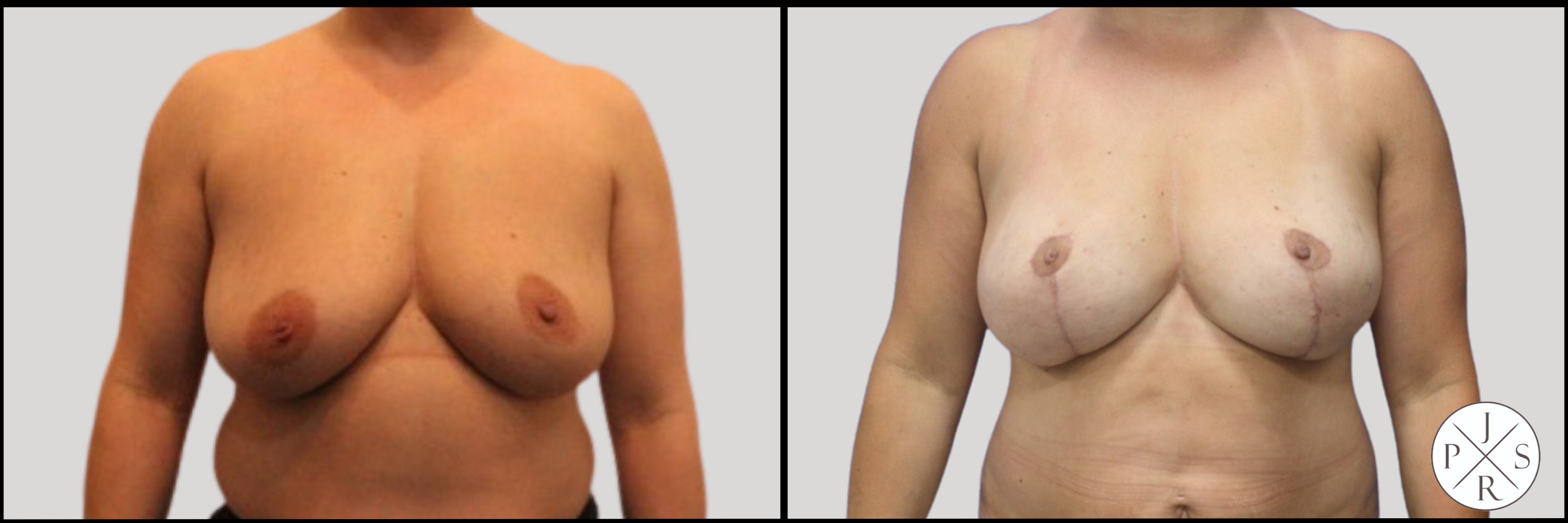 Fat Transfer Breast Augmentation Before & After Image